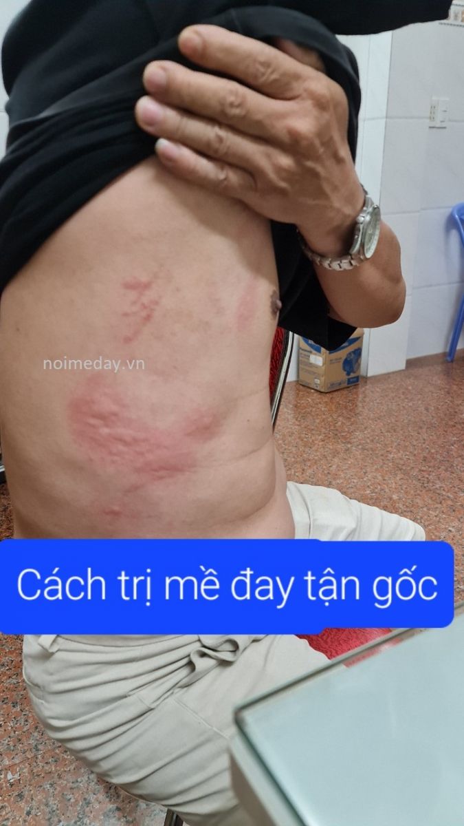 Cách chữa nổi mề đay tận gốc